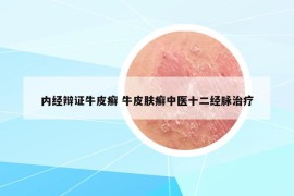 内经辩证牛皮癣 牛皮肤癣中医十二经脉治疗