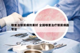 哪里治银屑病效果好 全国哪里治疗银屑病最专业