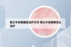 婴儿牛皮癣最佳治疗方法 婴儿牛皮肤癣怎么治疗