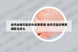 血热血燥引起的头皮银屑病 血热引起的银屑病能治愈么