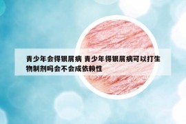 青少年会得银屑病 青少年得银屑病可以打生物制剂吗会不会成依赖性