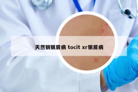 天然铜银屑病 tocit xr银屑病