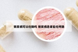 银屑病可以吃肠吗 银屑病患者能吃烤肠