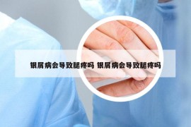 银屑病会导致腿疼吗 银屑病会导致腿疼吗