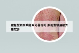 脓包型银屑病能用可善挺吗 脓疱型银屑病外用软膏