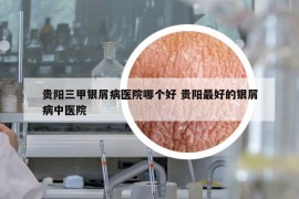 贵阳三甲银屑病医院哪个好 贵阳最好的银屑病中医院