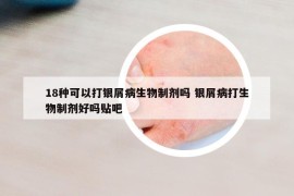 18种可以打银屑病生物制剂吗 银屑病打生物制剂好吗贴吧