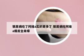 银屑病吃了阿维a出的更多了 银屑病吃阿维a爆皮全身痒