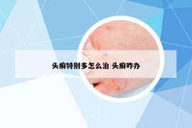 头癣特别多怎么治 头癣咋办