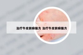 治疗牛皮肤癣偏方 治疗牛皮肤癣偏方