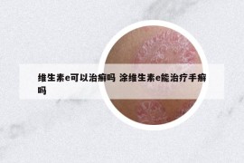 维生素e可以治癣吗 涂维生素e能治疗手癣吗