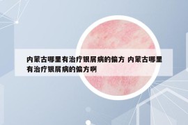 内蒙古哪里有治疗银屑病的偏方 内蒙古哪里有治疗银屑病的偏方啊