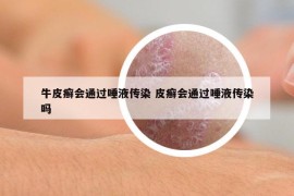 牛皮癣会通过唾液传染 皮癣会通过唾液传染吗