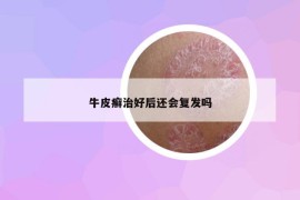 牛皮癣治好后还会复发吗