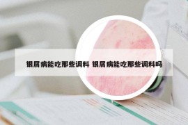 银屑病能吃那些调料 银屑病能吃那些调料吗