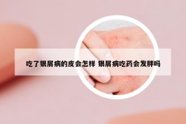 吃了银屑病的皮会怎样 银屑病吃药会发胖吗