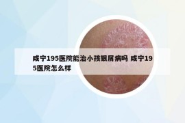 咸宁195医院能治小孩银屑病吗 咸宁195医院怎么样