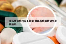 掌跖脓疱病传染不传染 掌跖脓疱病传染全身和脸吗