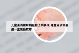 儿童点滴银屑病在脸上的表现 儿童点滴银屑病一直出新皮疹