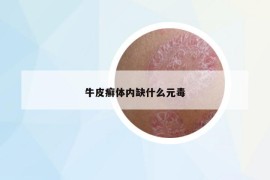 牛皮癣体内缺什么元毒