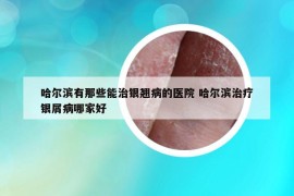 哈尔滨有那些能治银翘病的医院 哈尔滨治疗银屑病哪家好