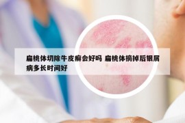 扁桃体切除牛皮癣会好吗 扁桃体摘掉后银屑病多长时间好