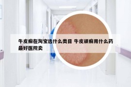 牛皮癣在淘宝选什么类目 牛皮顽癣用什么药最好医院卖