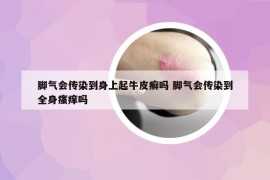 脚气会传染到身上起牛皮癣吗 脚气会传染到全身瘙痒吗