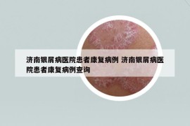 济南银屑病医院患者康复病例 济南银屑病医院患者康复病例查询