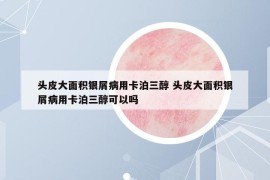 头皮大面积银屑病用卡泊三醇 头皮大面积银屑病用卡泊三醇可以吗