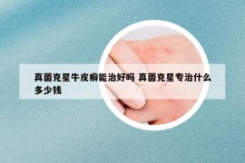 真菌克星牛皮癣能治好吗 真菌克星专治什么多少钱