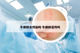 牛癖鲜会传染吗 牛癖鲜遗传吗