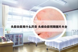 头藓白藓用什么药膏 头癣白藓初期图片大全