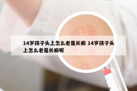 14岁孩子头上怎么老是长癣 14岁孩子头上怎么老是长癣呢