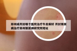 郑州或开封哪个医院治疗牛皮癣好 开封银屑病治疗郑州银屑病研究院地址