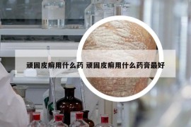 顽固皮癣用什么药 顽固皮癣用什么药膏最好