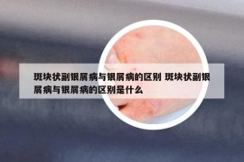 斑块状副银屑病与银屑病的区别 斑块状副银屑病与银屑病的区别是什么