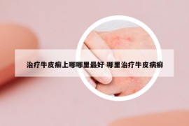 治疗牛皮癣上哪哪里最好 哪里治疗牛皮病癣