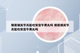 银屑病关节炎能吃安宫牛黄丸吗 银屑病关节炎能吃安宫牛黄丸吗