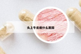 头上牛皮癣什么原因