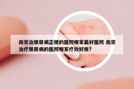 南京治银屑病正规的医院哪家最好医院 南京治疗银屑病的医院哪家疗效好些?