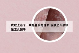 皮肤上涨了一块黑色癣是什么 皮肤上长黑块是怎么回事