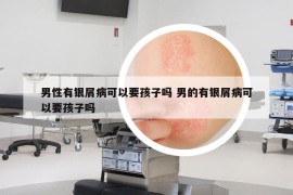 男性有银屑病可以要孩子吗 男的有银屑病可以要孩子吗