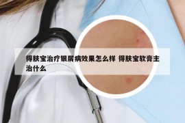 得肤宝治疗银屑病效果怎么样 得肤宝软膏主治什么