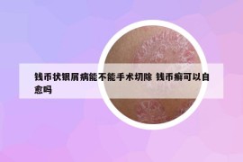 钱币状银屑病能不能手术切除 钱币癣可以自愈吗