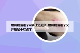 银屑病消退了可身上还在长 银屑病消退了又开始起小红点了