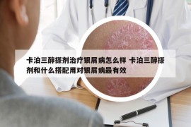 卡泊三醇搽剂治疗银屑病怎么样 卡泊三醇搽剂和什么搭配用对银屑病最有效