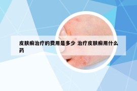 皮肤癣治疗的费用是多少 治疗皮肤癣用什么药