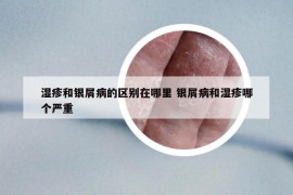 湿疹和银屑病的区别在哪里 银屑病和湿疹哪个严重