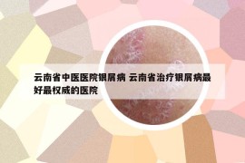 云南省中医医院银屑病 云南省治疗银屑病最好最权威的医院